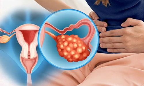PCOD and Hormonal Health